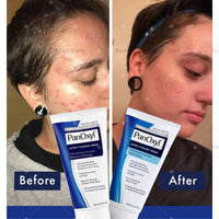 Thumbnail for PanOxyl Acne Foaming Wash - thedealzninja