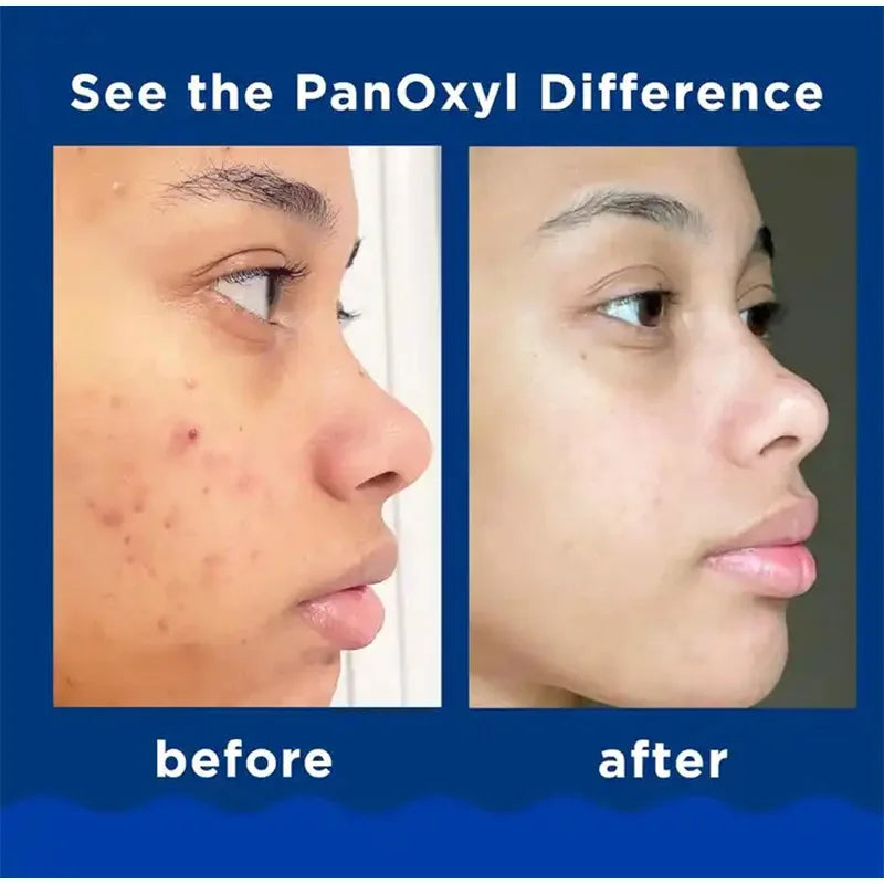 PanOxyl Acne Foaming Wash - thedealzninja