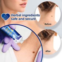 Thumbnail for WartsOff cream for immediate removal of skin impurities - thedealzninja