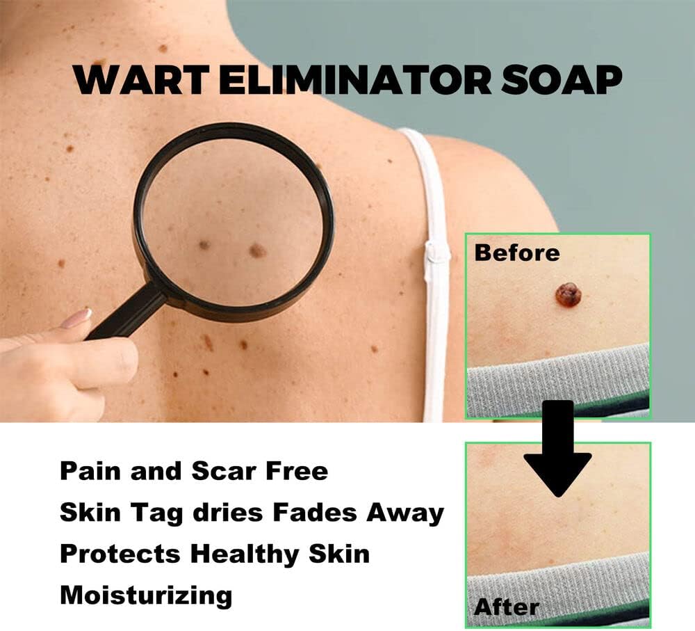 SmoothSkin Wart Eliminator Soap