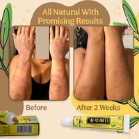 Thumbnail for Herbal Healing Cream Eczema and Psoriasis - thedealzninja