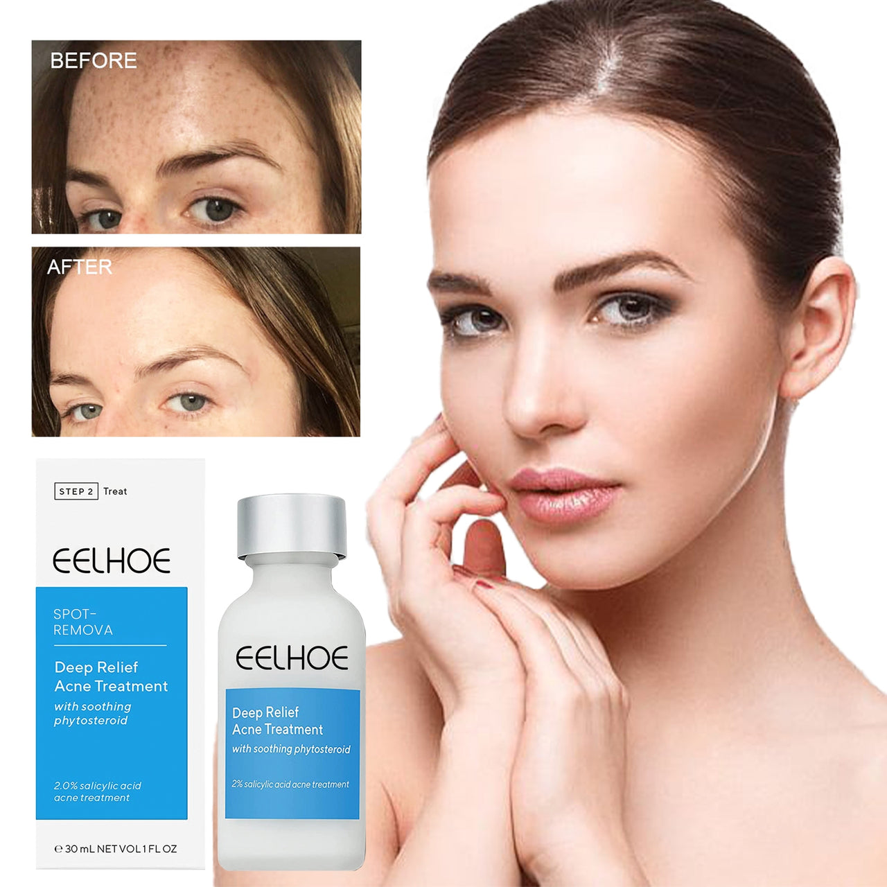 EELHOE™ Dark Spot and Acne Treatment Lotion - thedealzninja