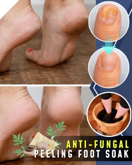 Anti-fungal Peeling Foot Soak - thedealzninja