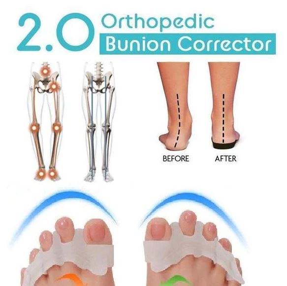 Orthopedic Bunion Corrector 2.0(1 PAIR) - thedealzninja