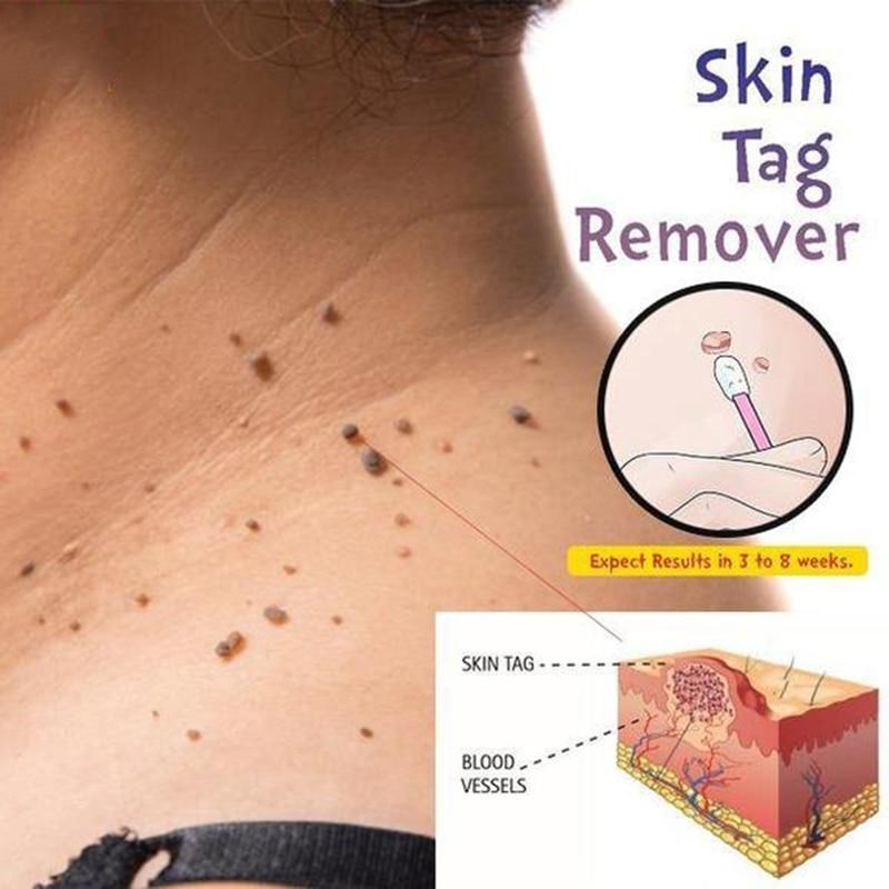 Skin Tag Remover - thedealzninja