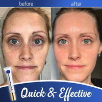 Thumbnail for Anti-Freckle & TagOut Mole Removal Cream - thedealzninja