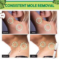 Thumbnail for Natural Medi-Grade Tags and Moles Remover - thedealzninja