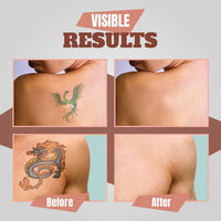 Thumbnail for 7 days Tattoo Removal Cream - thedealzninja