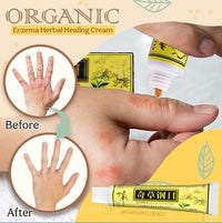 Thumbnail for Herbal Healing Cream Eczema and Psoriasis - thedealzninja
