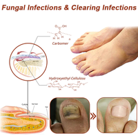 Thumbnail for Oveallgo™ Revolutionary High-Efficiency Light Therapy Device For Toenail Diseases