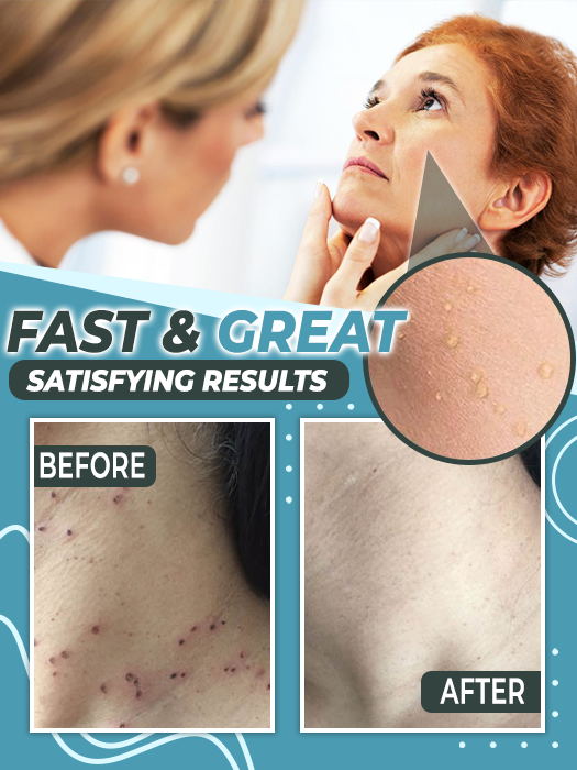Skin Tag Remover Patch - thedealzninja