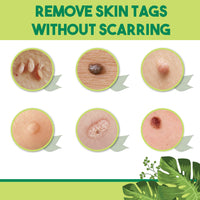 Thumbnail for Natural Medi-Grade Tags and Moles Remover - thedealzninja