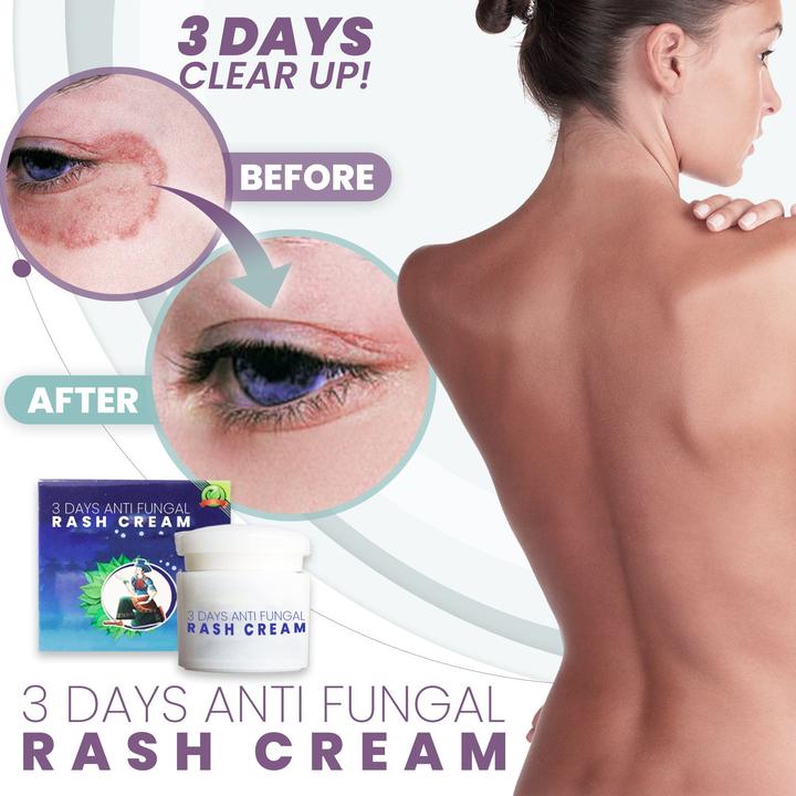 3 Days Anti Fungal Rash Cream - thedealzninja