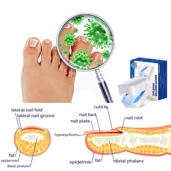 Oveallgo™ Revolutionary High-Efficiency Light Therapy Device For Toenail Diseases
