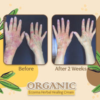 Thumbnail for Organic Eczema Herbal Healing Cream - thedealzninja