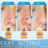 Thumbnail for Derma'Pro Mole & Wart Remove Treatment Set - thedealzninja