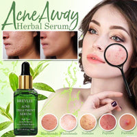 Thumbnail for AcneAway Herbal Serum - thedealzninja
