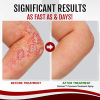 Thumbnail for Dermax™ Psoriasis Treatment Spray - thedealzninja