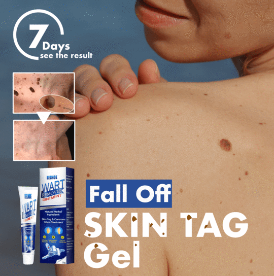 Fall Off Skin Tag Gel - thedealzninja
